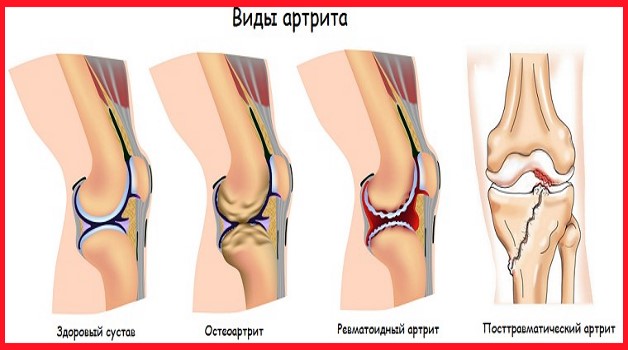 разновидности коленного артрита