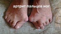 артрит пальцев ног