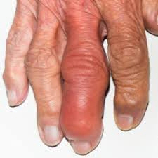 Воспаленный палец руки