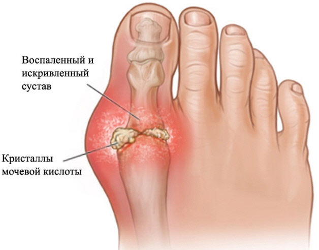 Воспаленный сустав пальца ноги