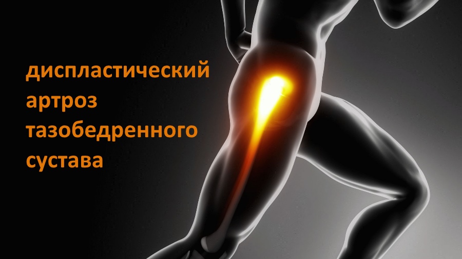 Диспластический коксартроз тазобедренного сустава: признаки и степени ...