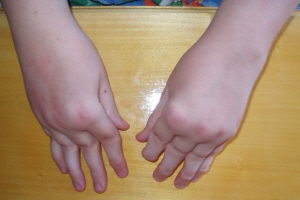 Искривленные пальцы у ребенка