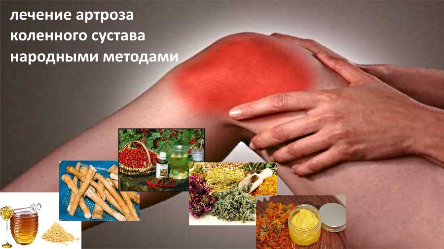 13 способов народного лечения артроза коленного сустава