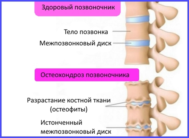 поражённый остеохондрозом позвоночник