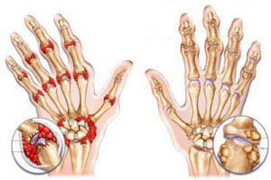 Пораженные артритом пальцы
