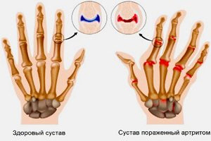 Поврежденные болезнью пальцы