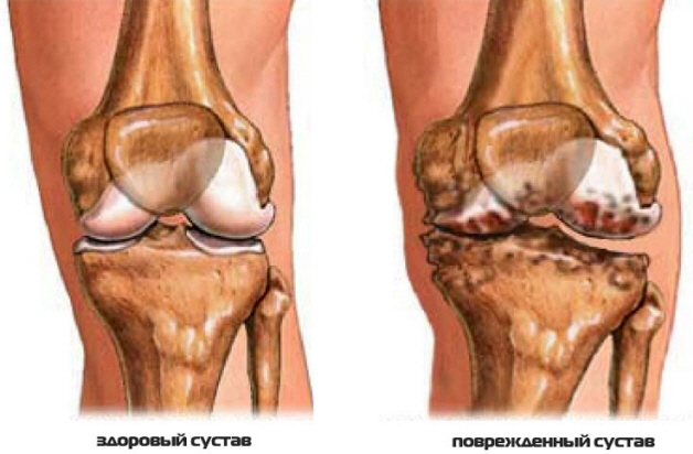 Поврежденный сустав колена