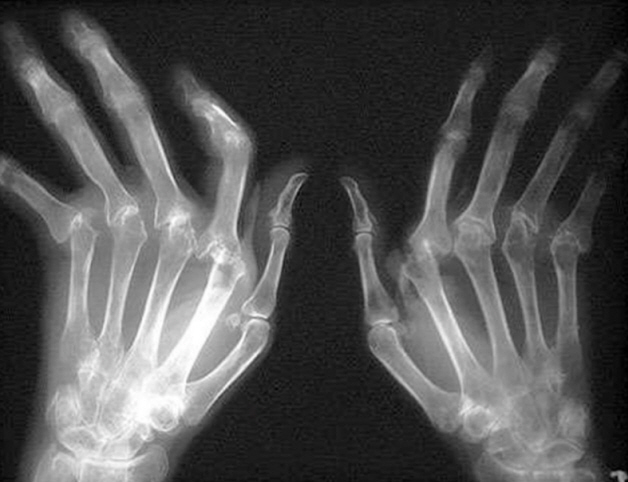 Рентген кисти руки