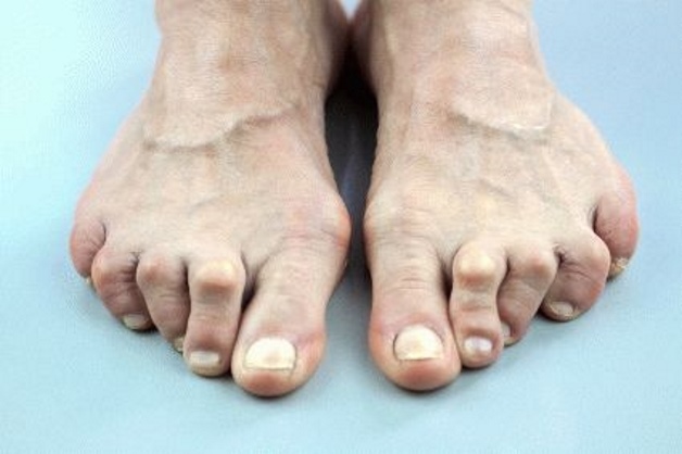 Ревматоидный артрит чаще поражает пальцы стопы со 2 по 5