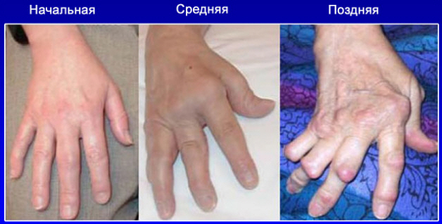 Стадии артрита пальцев рук