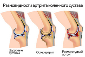 Внешний вид больного колена