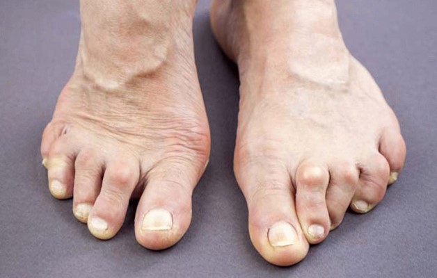 При артрите опухают пальцы на ногах