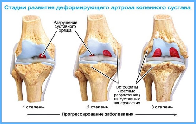 Деформация коленного сустава при артрозе фото thumbnail