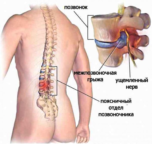 Лечение остеохондроза поясничного отдела физиотерапия thumbnail