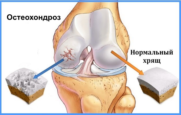 Лечение остеохондроза коленного сустава thumbnail