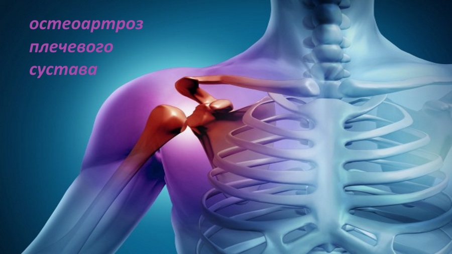 Деформирующий артроз плечевого сустава: степени и признаки заболевания ...