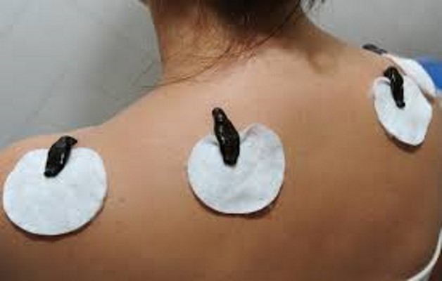 Изображение - Эффективное лечение артроза плечевого сустава girudoterapija