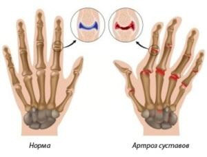 Узелковый артроз пальцев рук в руки thumbnail