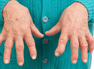 Ревматоидный артрит серопозитивный полиартрит лечение народными средствами thumbnail