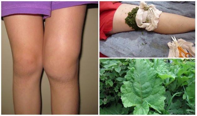 Артроз колена лечение народными способами thumbnail