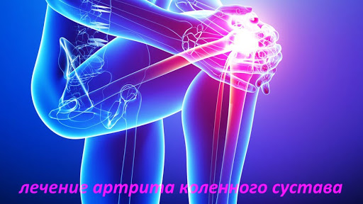 Лечение артрита коленного сустава: медикаментозные и народные средства