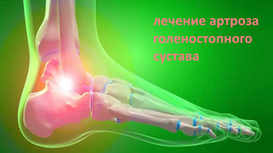 Лечение артроза голеностопного сустава - применение таблеток, уколов ...