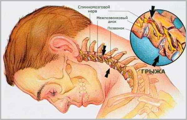 лечение грыжи в шее