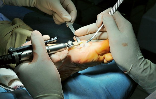 Изображение - Лечение суставов пальцев стопы ног operaciya-na-kostochke-bolshogo-palca-nogi