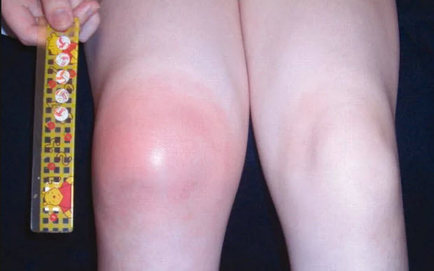 Острый артрит коленного сустава у детей лечение thumbnail