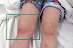 Ревматоидный артрит ребенку 3 года thumbnail