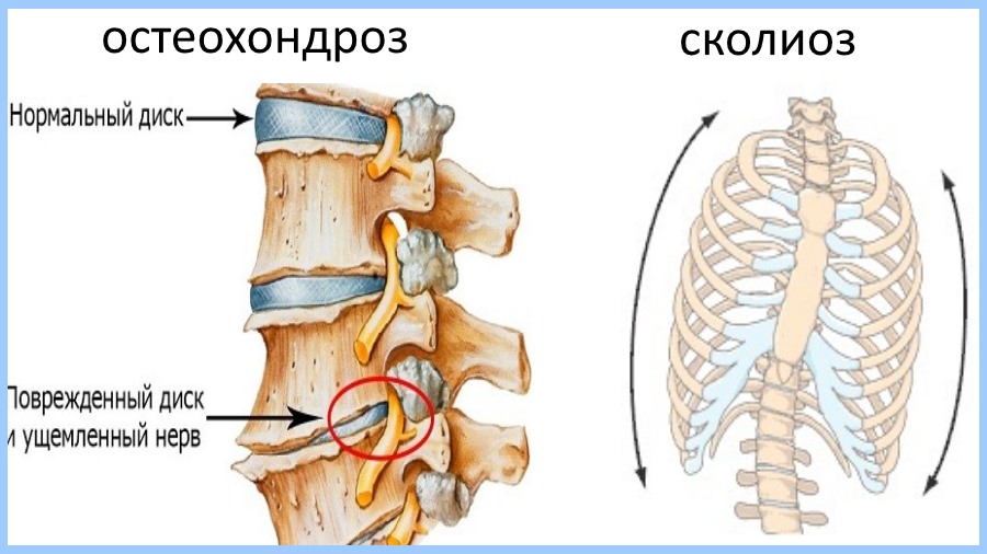 Сколиоз и остеохондроз грудного отдела