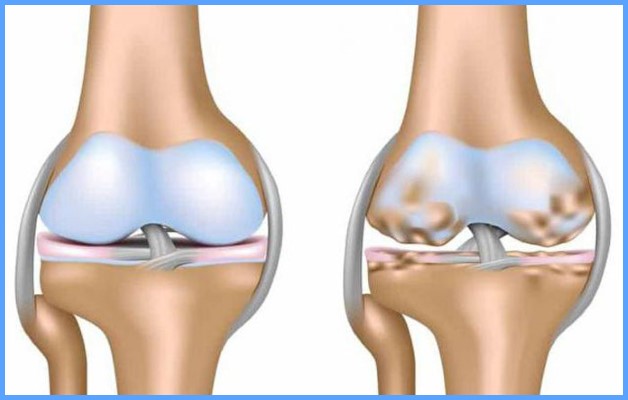 Остеохондроз коленных суставов и его лечение thumbnail