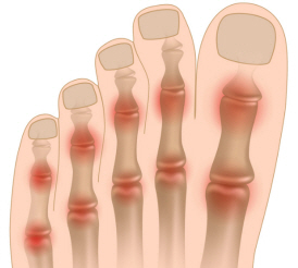Подагрический артрит стопы симптомы и лечение thumbnail