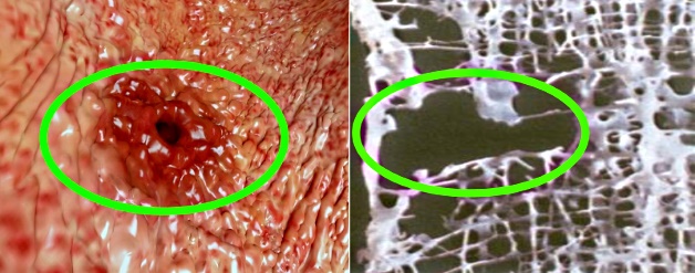 Изображение - Что можно есть при ревматоидном артрите суставов pobochnye-jeffekty-pri-lechenii-revmatoidnogo-artrita