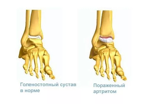 Реактивный артрит голеностопного сустава симптомы и лечение thumbnail