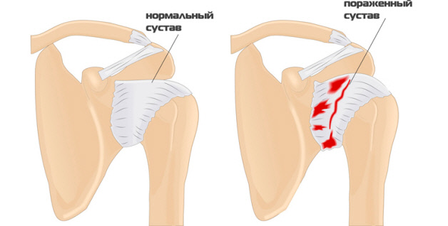 Поражение плечевого сустава при ревматоидном артрите thumbnail
