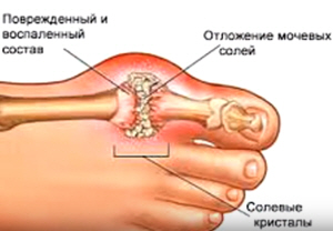 Подагрический артрит рук лечение народными средствами thumbnail
