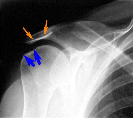 Признаки ревматоидного артрита плечевого сустава thumbnail