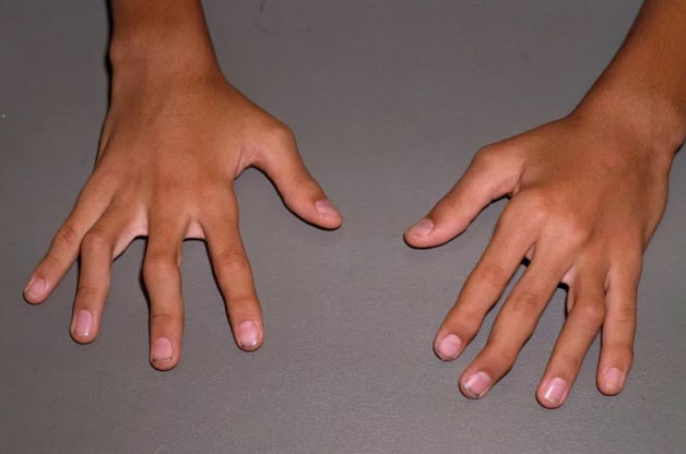 Ревматоидный артрит у детей сыпь thumbnail