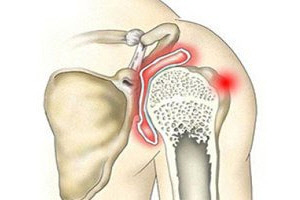 Ревматизм плечевого сустава симптомы лечение thumbnail
