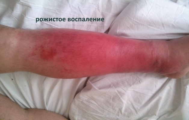 Изображение - Гнойный артрит коленного сустава лечение rozhistoe-vospalenie