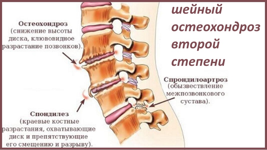 Мр картина остеохондроза шейного отдела позвоночника