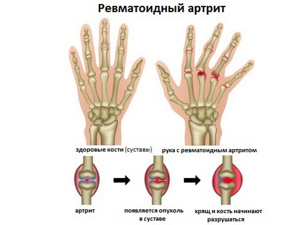 Ревматоидный артрит пальцев рук можно вылечить thumbnail