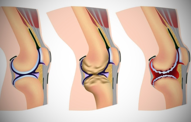 Артроз коленного сустава признаки и характеристика заболевания thumbnail