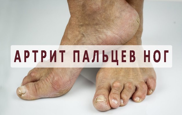 степень артрита пальцев ног