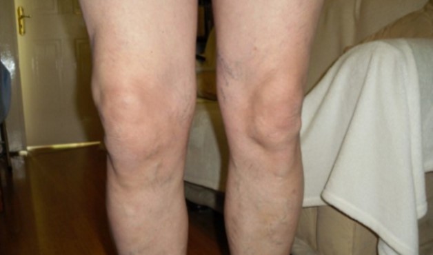 деформация коленного сустава без болей thumbnail
